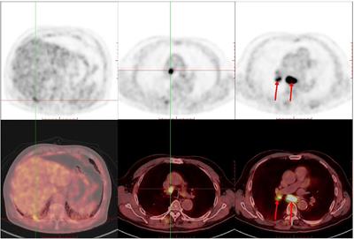 Case Report: Abscopal Effect of Microwave Ablation in a Patient With Advanced Squamous NSCLC and Resistance to Immunotherapy